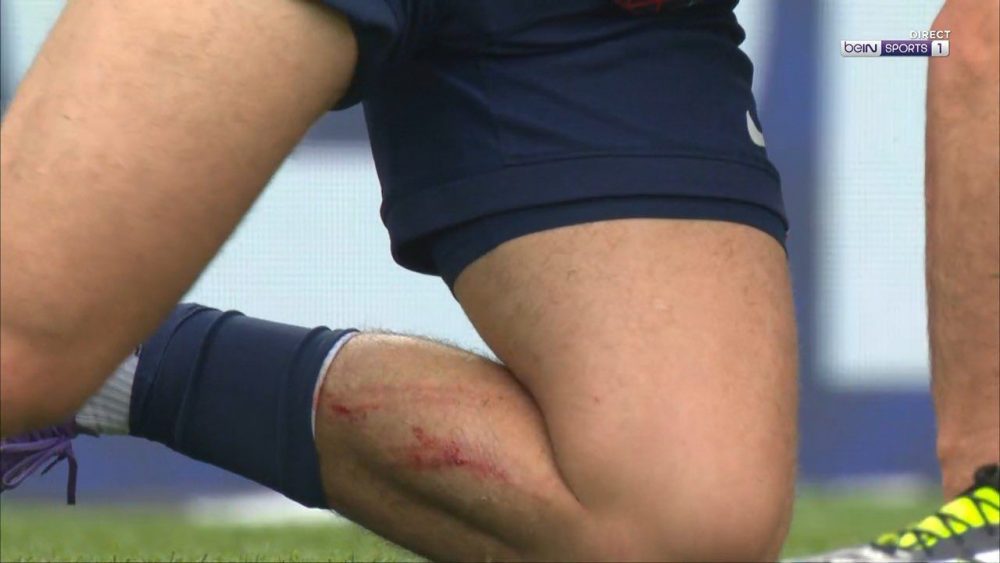 PSG vs Lens – Another Parisian striker injured!  